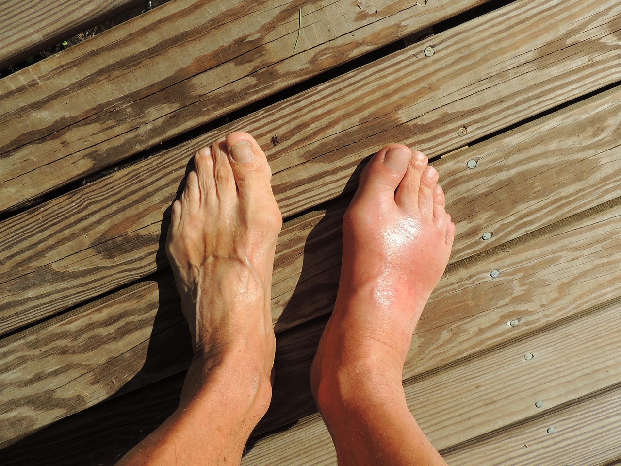 Discover 10 remedies for gout, including natural treatments and lifestyle tips, and learn how Charel Spa and Massage can help relieve the pain and improve joint health.